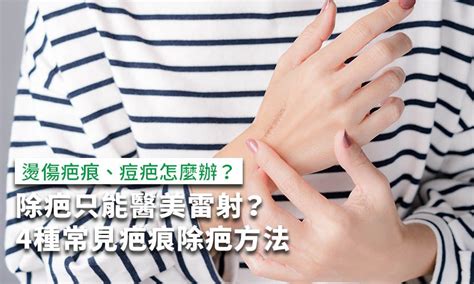 臉上有疤|除疤只能醫美雷射？燙傷、痘疤4種疤痕除疤方法一次。